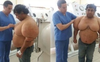 Peruvian Man Suffers from Rare Illness After Diving Incident